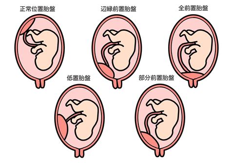 胎盤前置|前置胎盤について